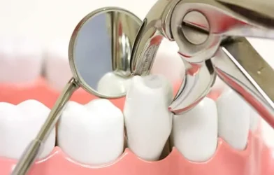 کشیدن دندان