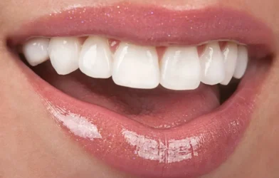 لمینت دندان