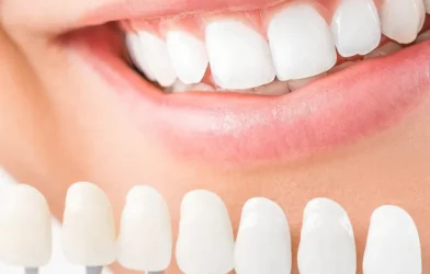 کامپوزیت ونیر